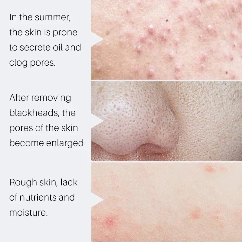Salicylic Acid Pore Shrinking  - Salicylic Acid Blackhead Remover ulasan dan harga